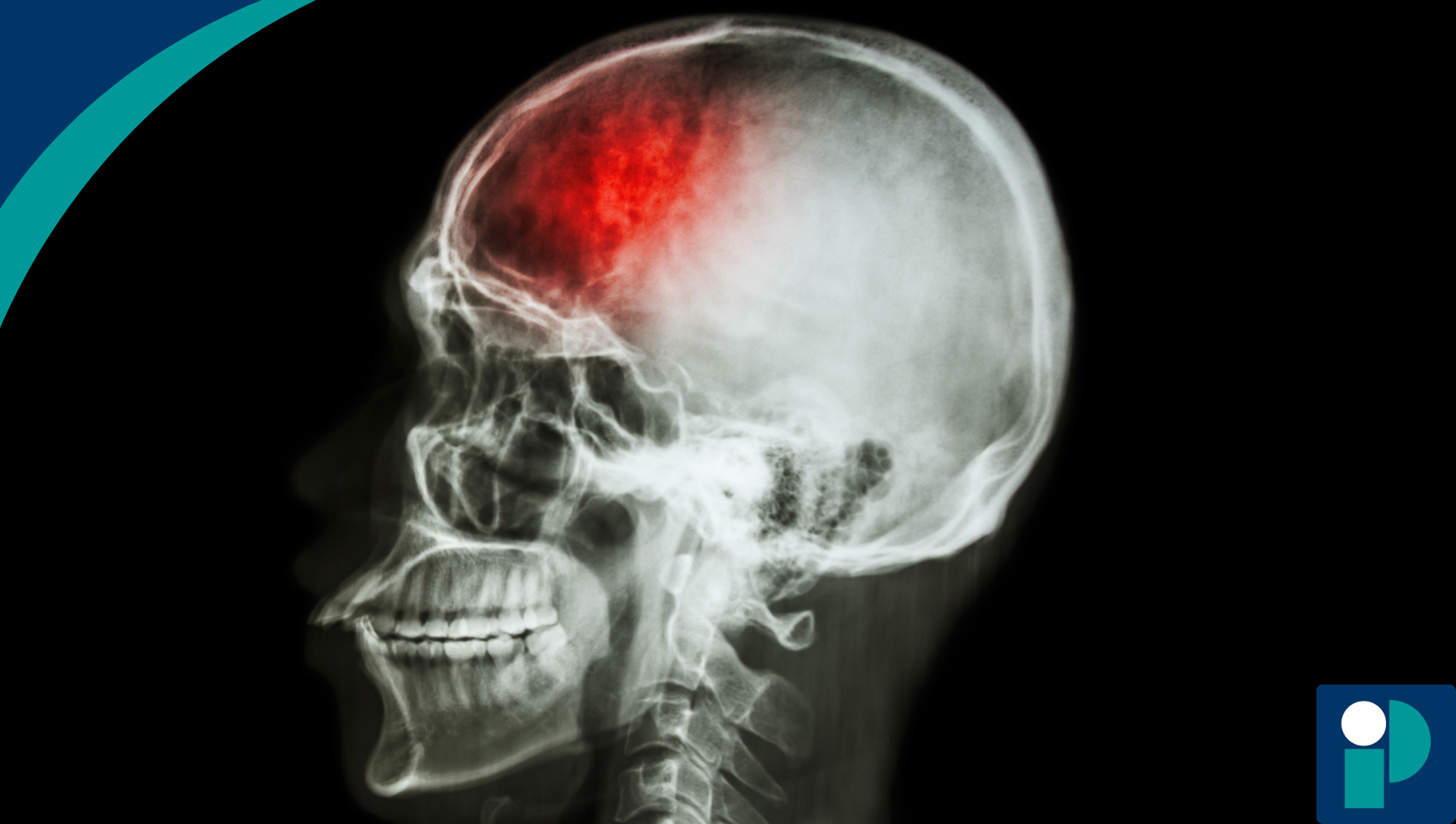 Prueba de sangre ambulatoria podría identificar rápidamente el tipo de  derrame cerebral en un paciente - Phlatames, image size:2100x1189