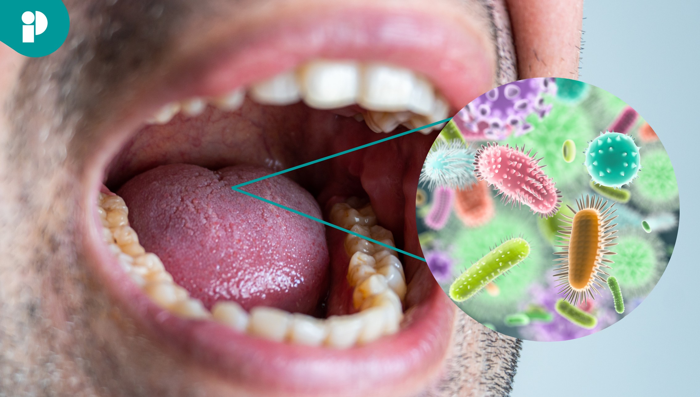 Algunas bacterias en la boca están relacionadas con la demencia y ...