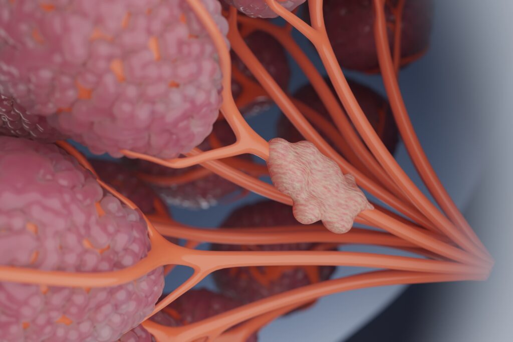 breast,cancer,cells,on,a,woman's,chest,,conveying,the,radiotherapy