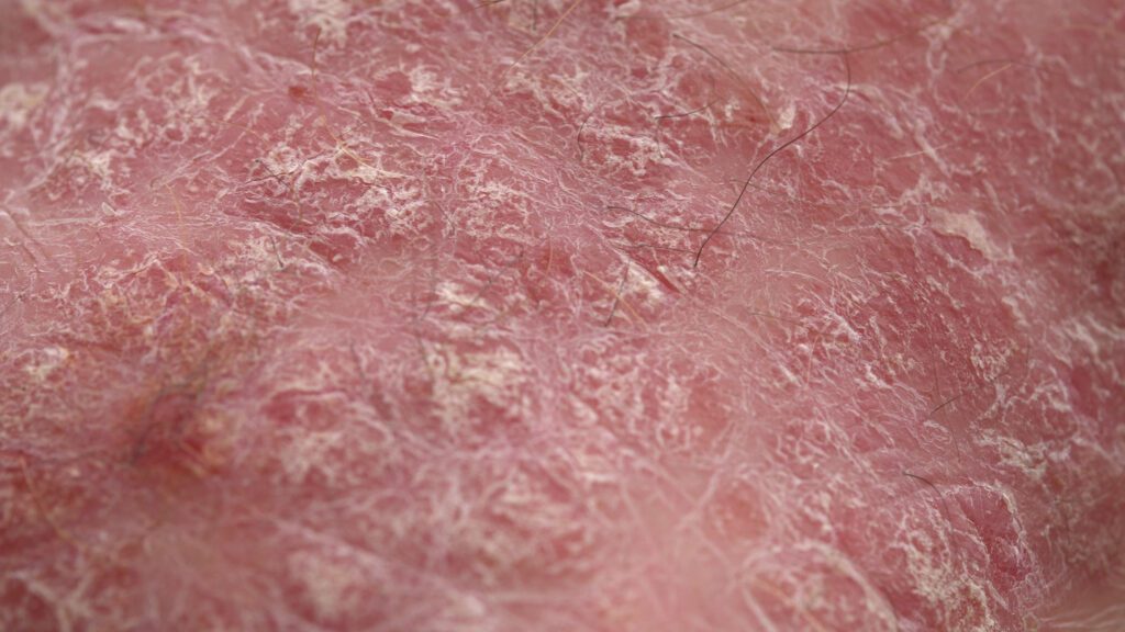 psoriasis,plaques,close up.,the,skin,of,a,patient,with,psoriasis