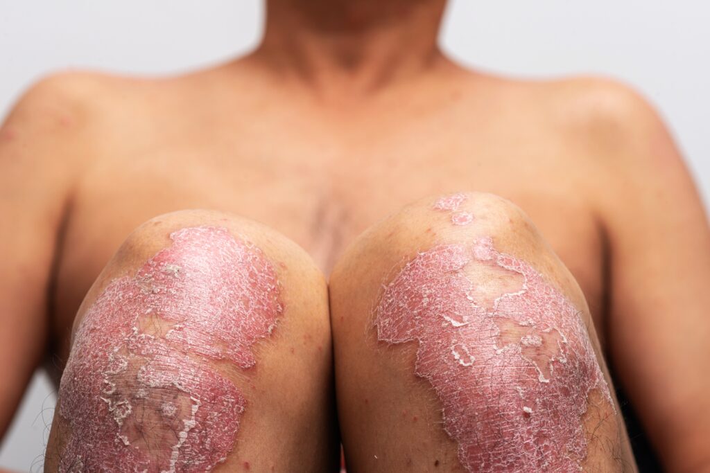 psoriasis,is,that,knee,on,white,background.