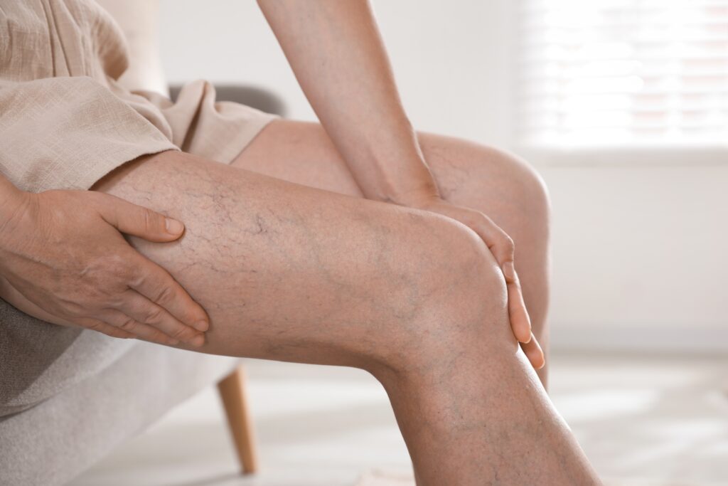 woman,suffering,from,varicose,veins,on,sofa,indoors,,closeup