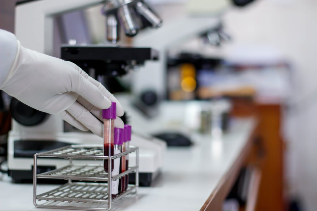 the,blood,in,edta,tube,for,test,complete,blood,count