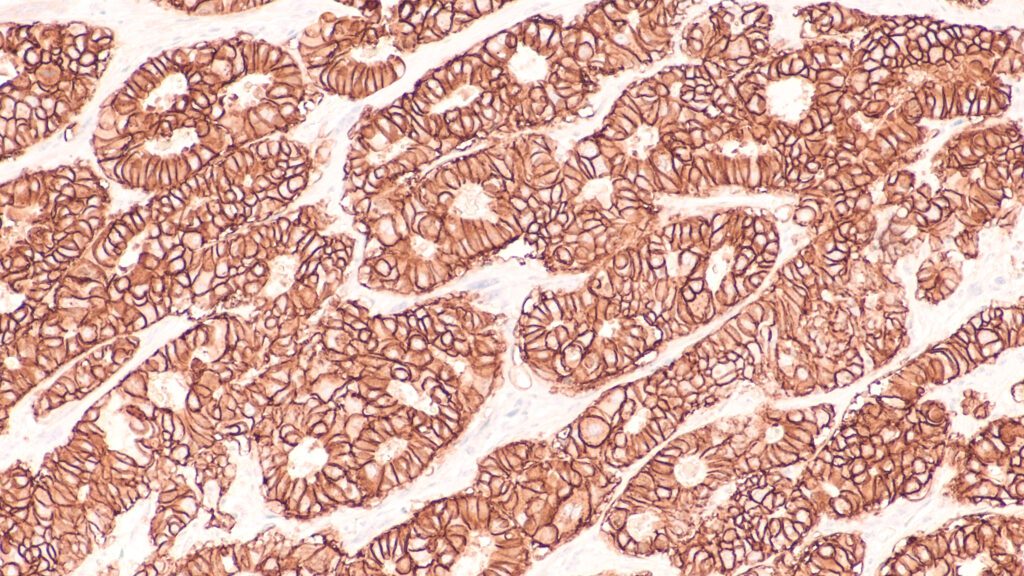 breast,cancer,pathology,research:,immunohistochemistry,for,her2,shows,positive,cell