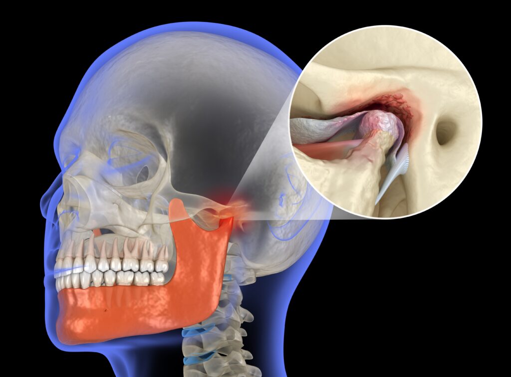 temporomandibular,joints,arthritis,and,dislocated,articular,disc.,medical,3d,illustration.