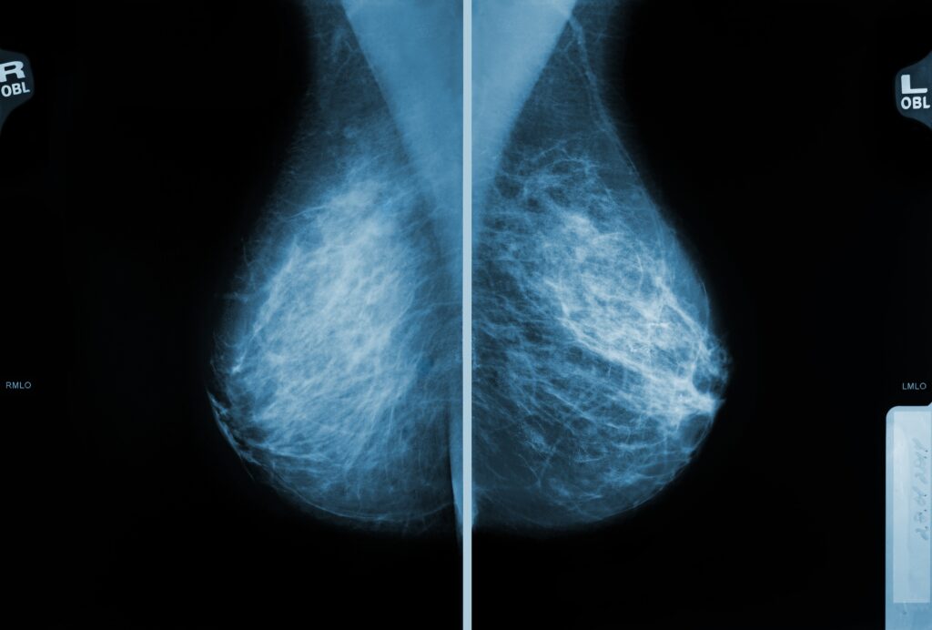 mammogram,images,showing,breast,tissue,for,medical,examination,and,diagnosis