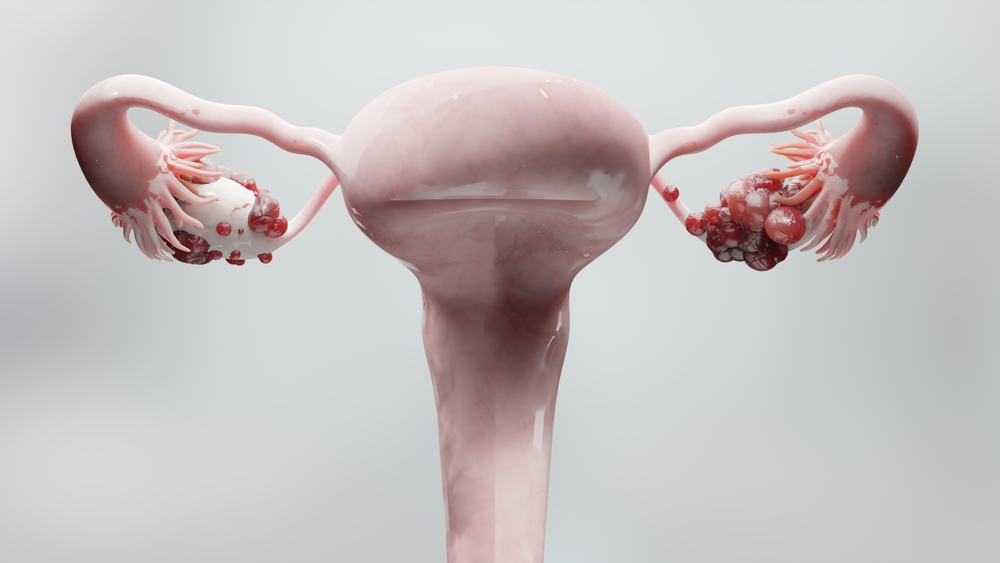 ovarian,malignant,tumor,,female,uterus,anatomy,,reproductive,system,,cancer,cells,