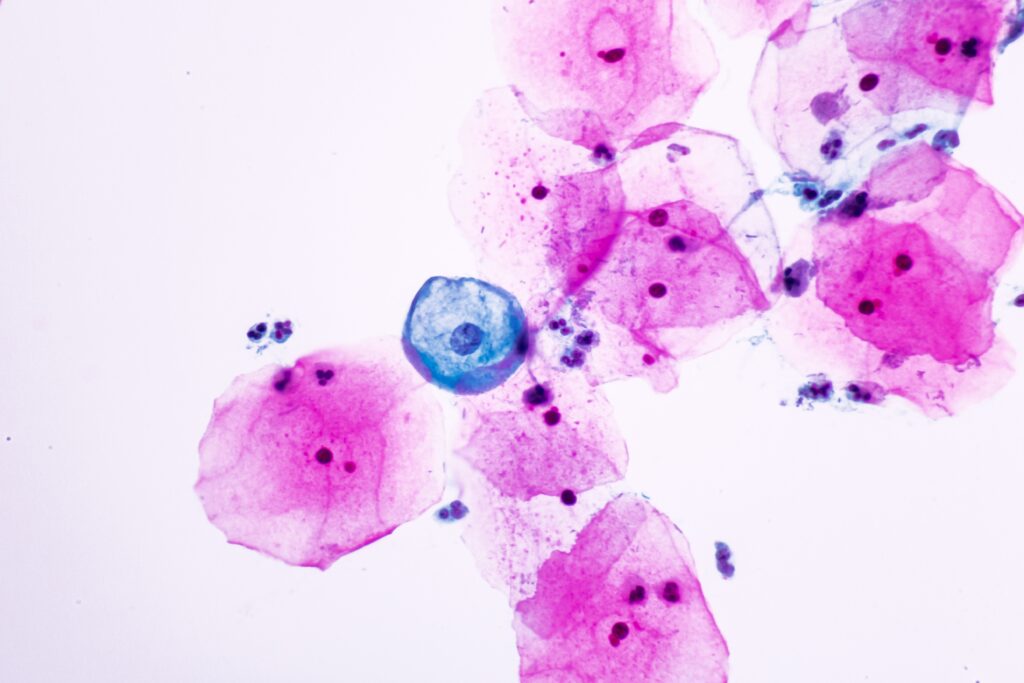 view,in,microscopic,of,koilocyte,cell,criteria,of,hpv,(human