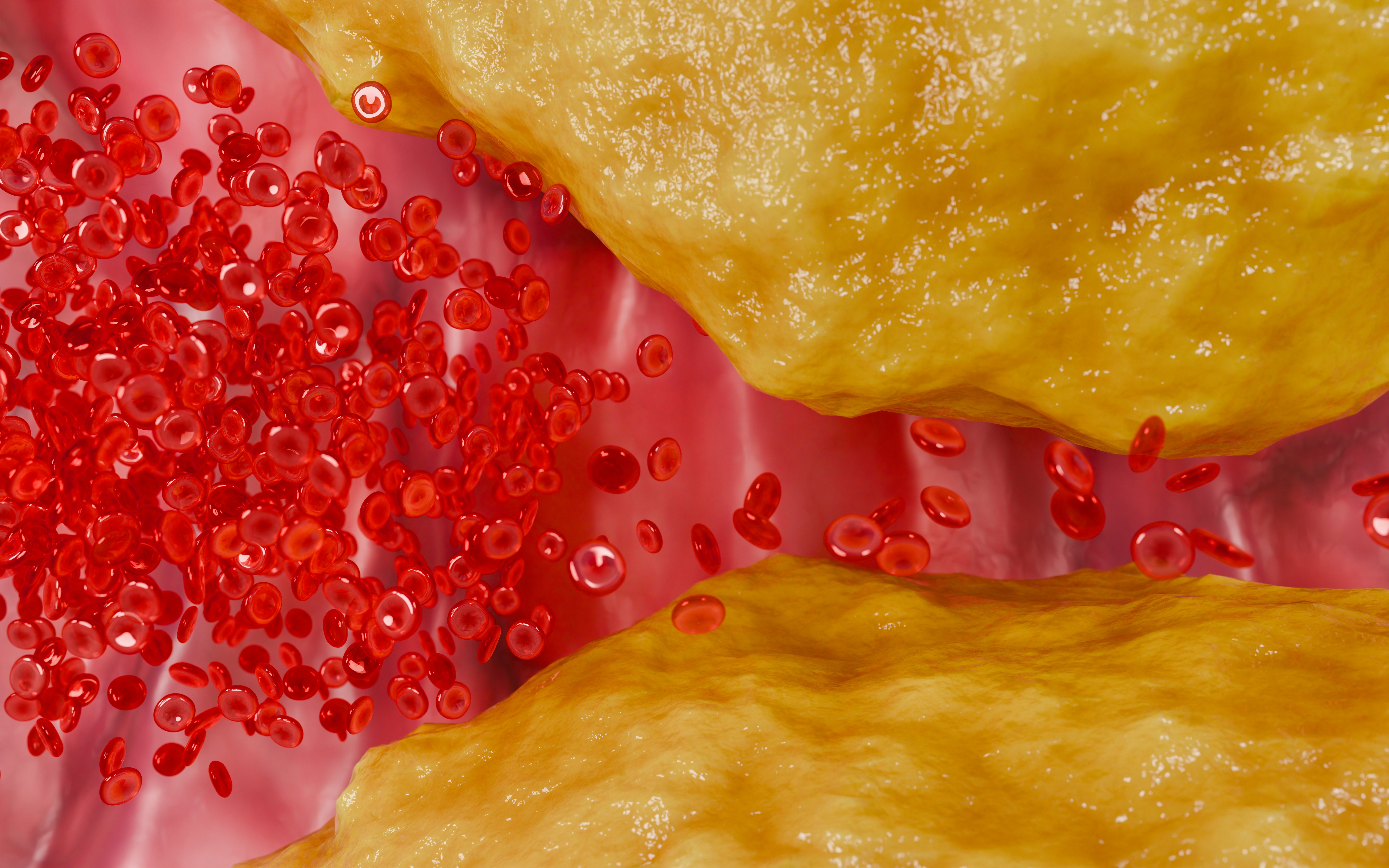 cholesterol,plaque,buildup,narrowing,artery,walls,and,restricting,blood,circulation