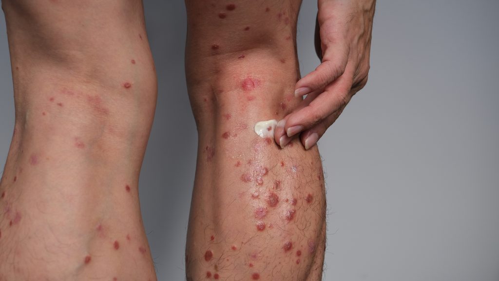 a,man,is,applying,psoriasis,cream,on,his,leg.