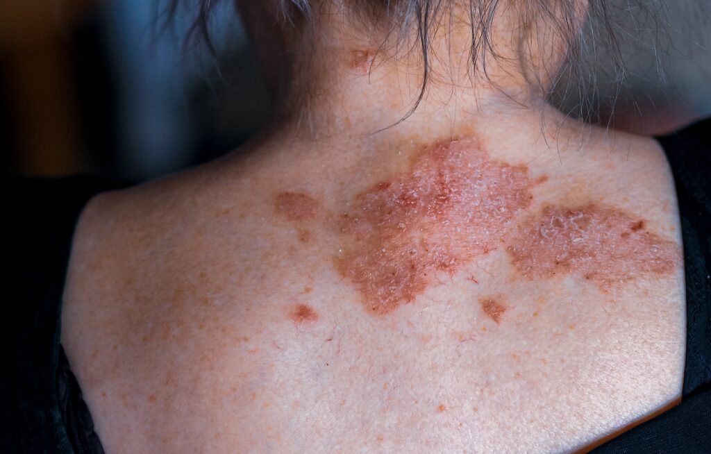 large,patches,of,psoriasis,on,womans,upper,back.,psoriasis,causes